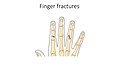 Finger fractures