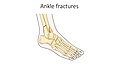 Ankle fractures