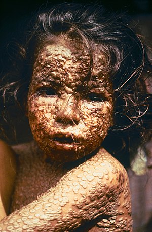 girl was infected with smallpox