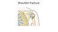 Shoulder fracture