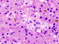Histopatologický obraz hepatocelulárního karcinomu u pacientky s chronickou jaterní cirhózou indukovanou infekcí HCV