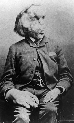 Joseph Merrick carte de visite photo, c. 1889