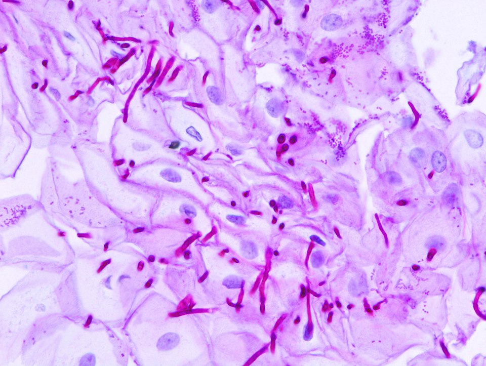 Soubor:Esophageal candidiasis (2) PAS stain.jpg