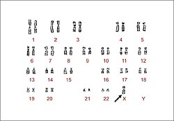 Monozomie (Turnerův syndrom 45,X)